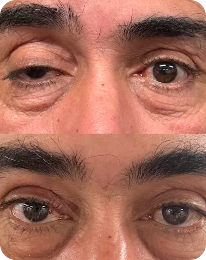 Antes e depois de blefaroplastia superior — resultado natural sem cicatrizes visíveis