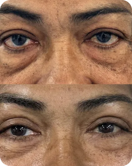 Resultado de cirurgia das pálpebras com olhar rejuvenescido e expressão natural