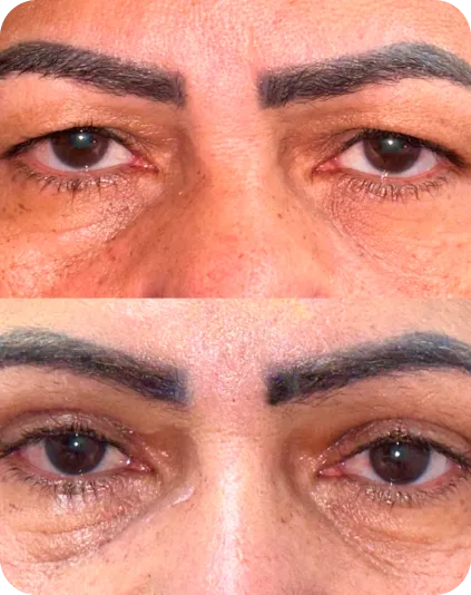 Blefaroplastia inferior — remoção de bolsas de gordura com resultado discreto