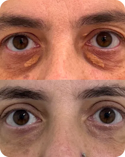 Correção de ptose palpebral — pálpebra caída corrigida com olhar mais aberto