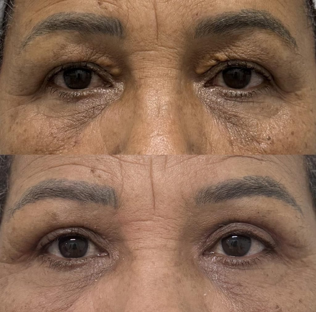 Resultado de blefaroplastia superior — olhar mais jovem preservando expressão natural