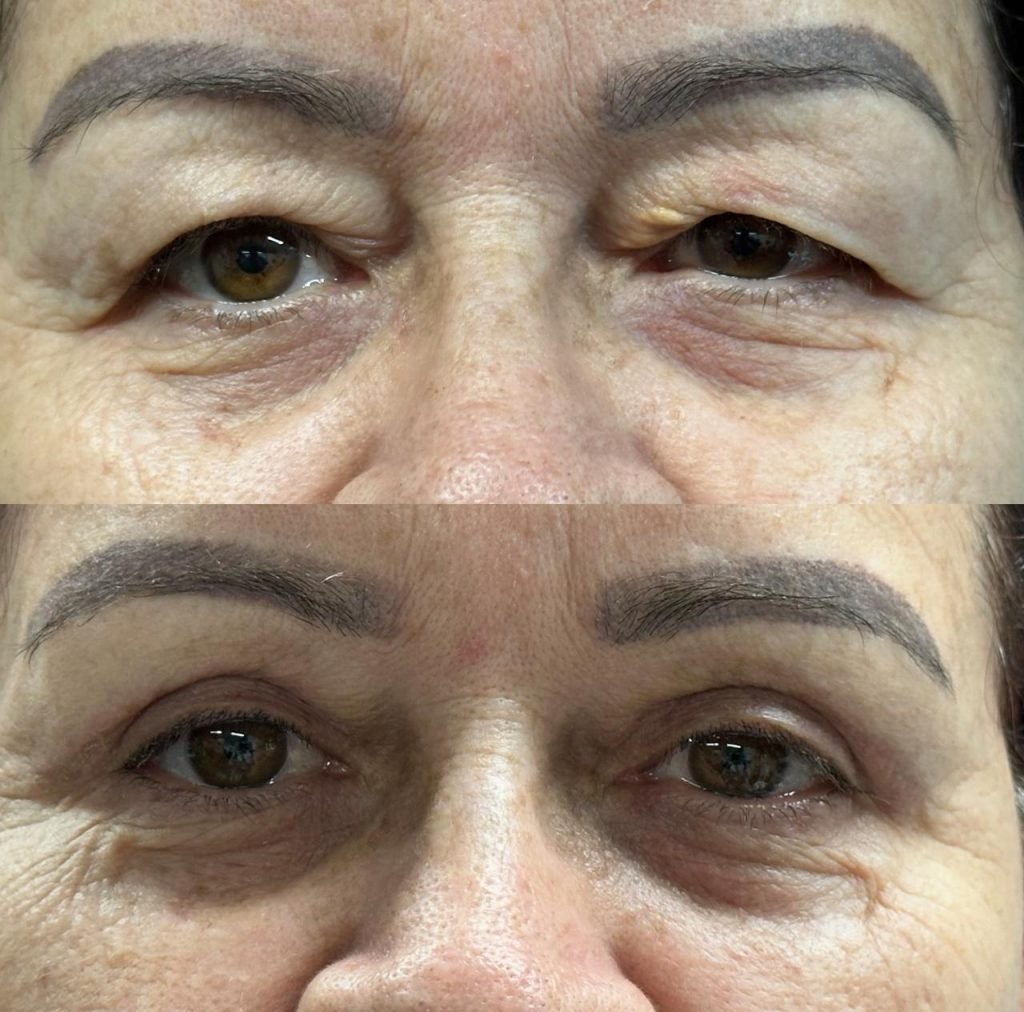 Paciente após blefaroplastia com a Dra. Thaís Borghi em São José do Rio Preto