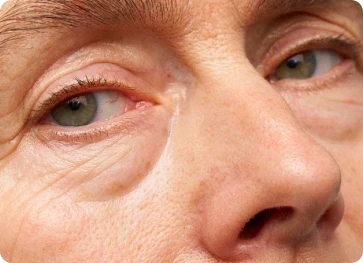 Bolsas e inchaços sob os olhos que afetam a autoestima