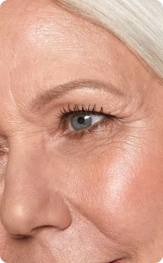 Ptose palpebral