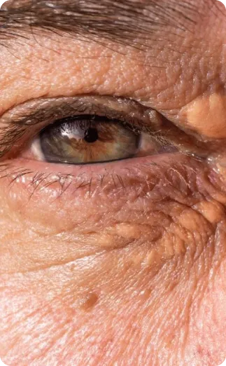 Xantelasma